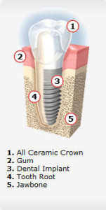 Calgary dental implants